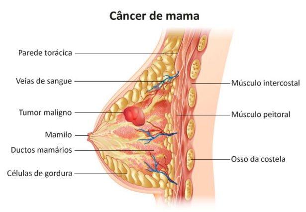 Cancer-de-mama.jpg